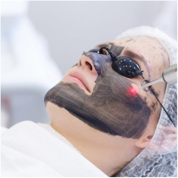 Лазерен карбонов пилинг - Hollywood peeling-процедура